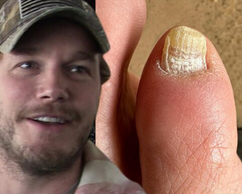 Chris Pratt Diagnosed With Toe Fungus by 'My Feet Are Killing Me' Doctor