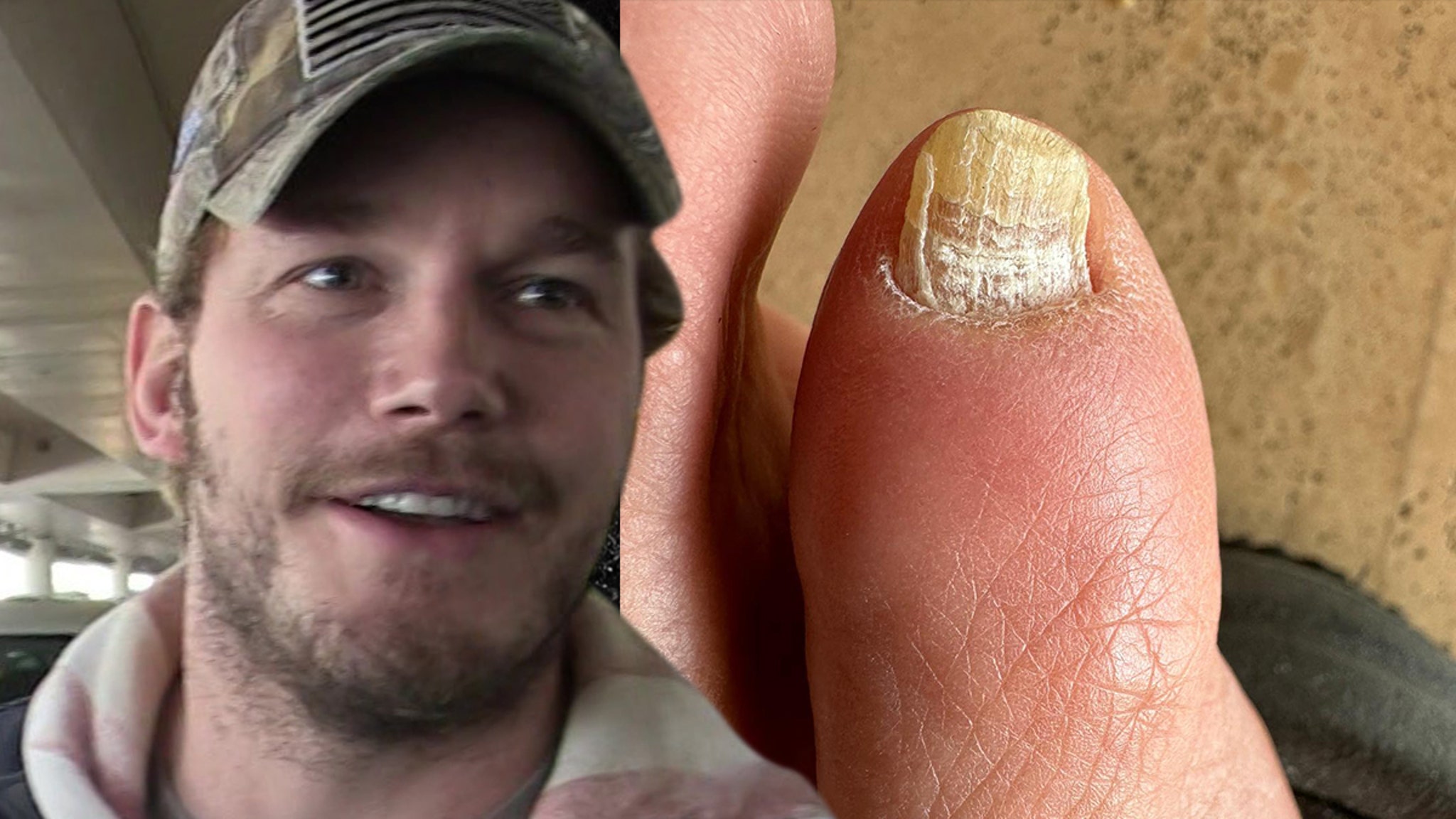 Chris Pratt Diagnosed With Toe Fungus by 'My Feet Are Killing Me' Doctor